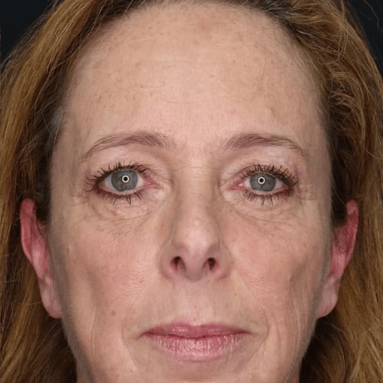 After microneedling treatment glowing skin result