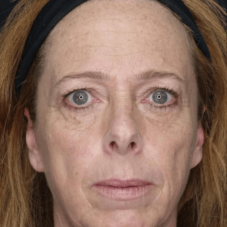 Before microneedling treatment