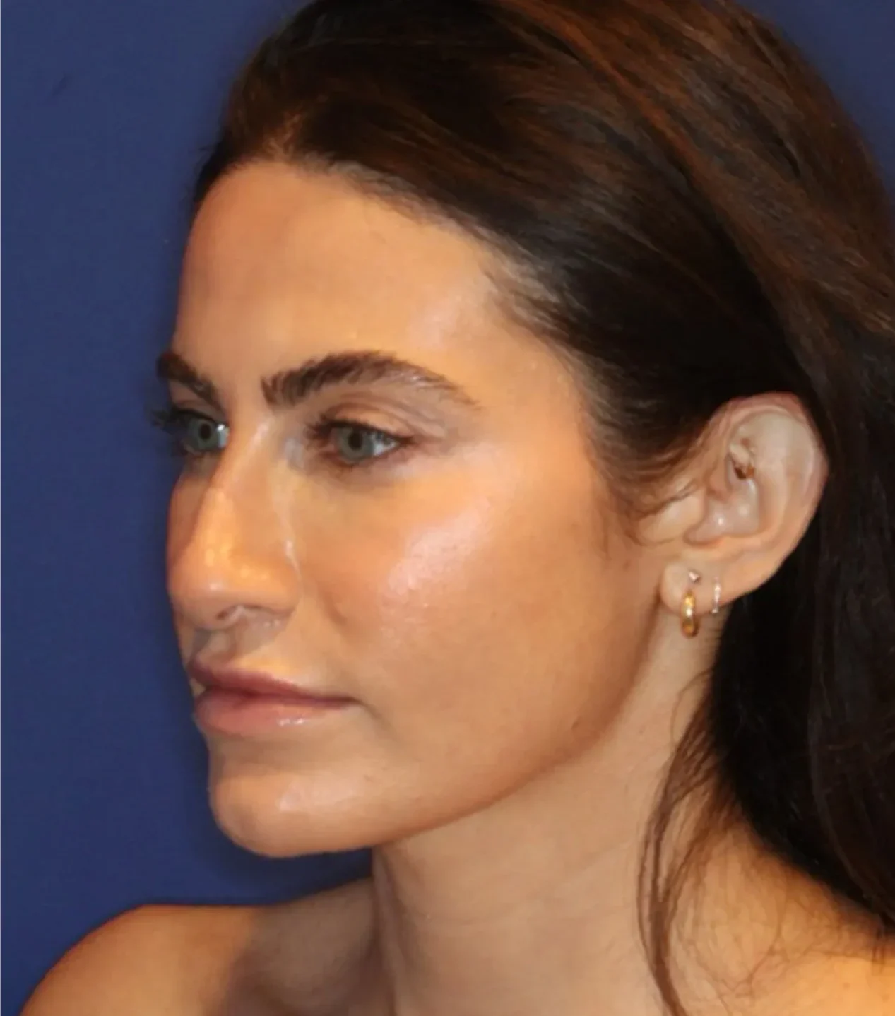 Before Skin Tightening treatment at LIV Med Spa Spring TX
