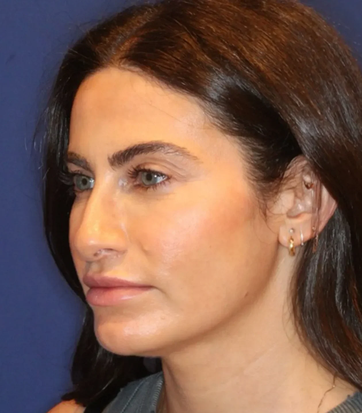 After Skin Tightening Neck treatment result at LIV Med Spa Spring TX