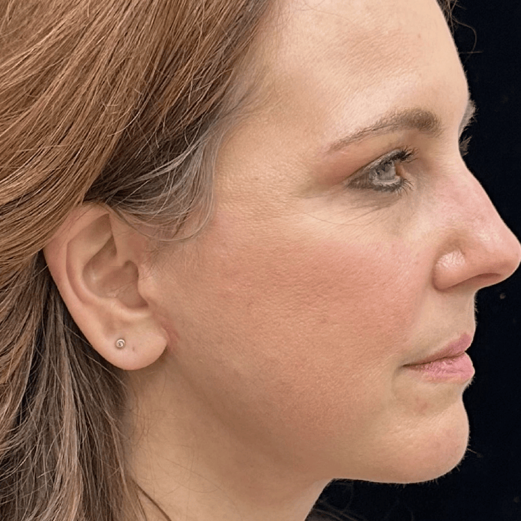 After laser skin treatment clear skin result