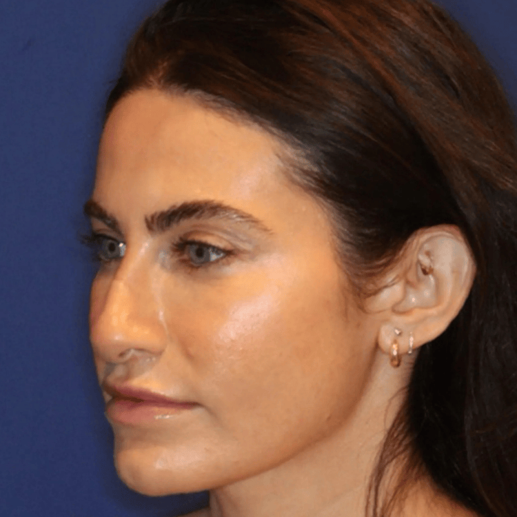 After chemical peel radiant skin result