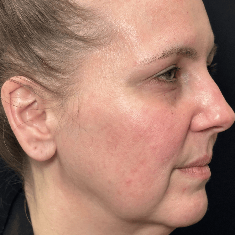 Before laser skin treatment
