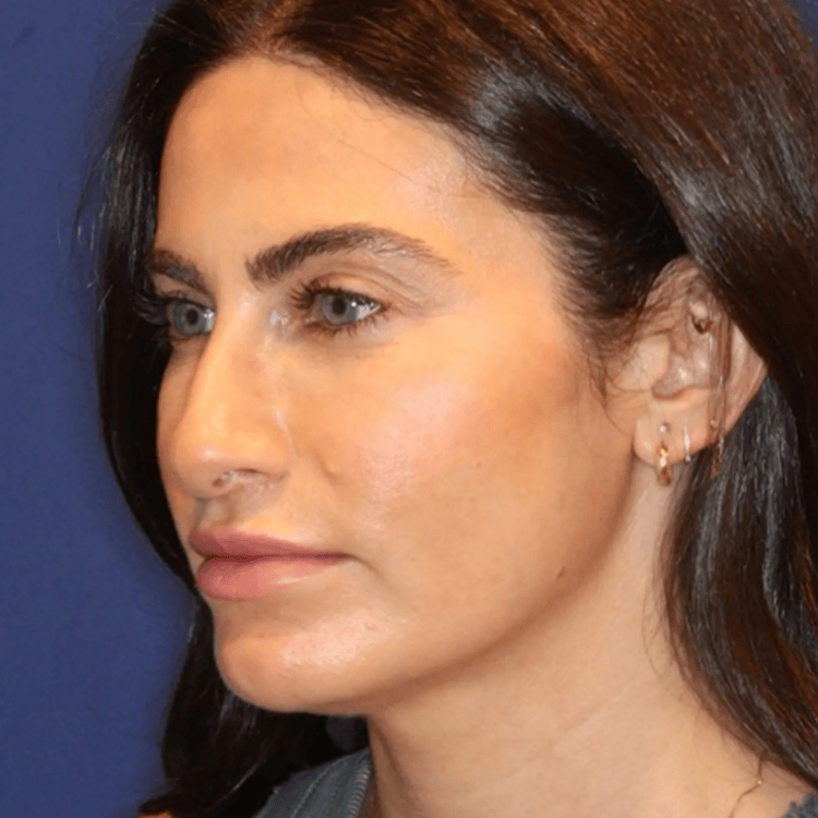 Before chemical peel treatment