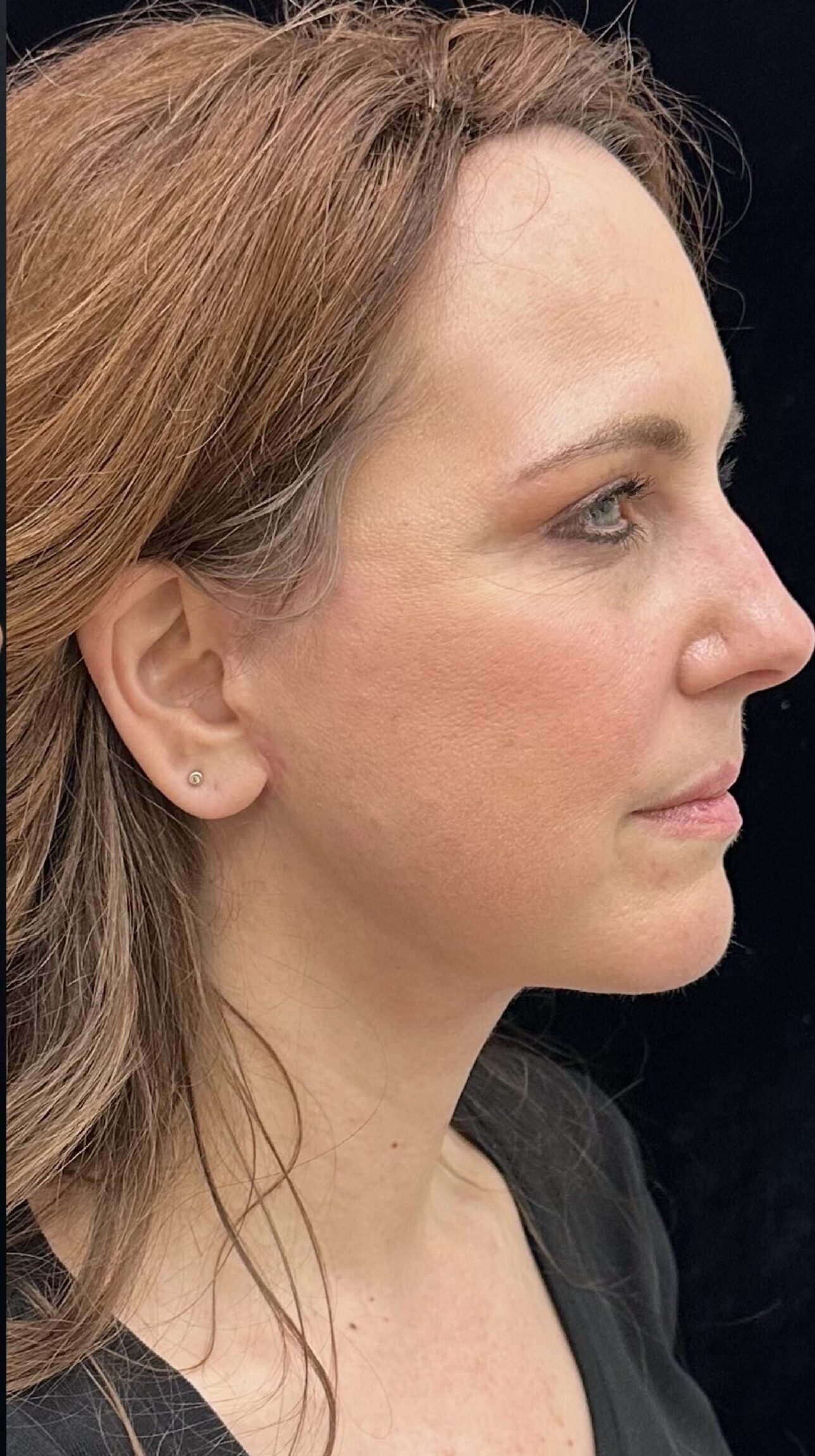 Before Botox Forehead treatment at LIV Med Spa Spring TX
