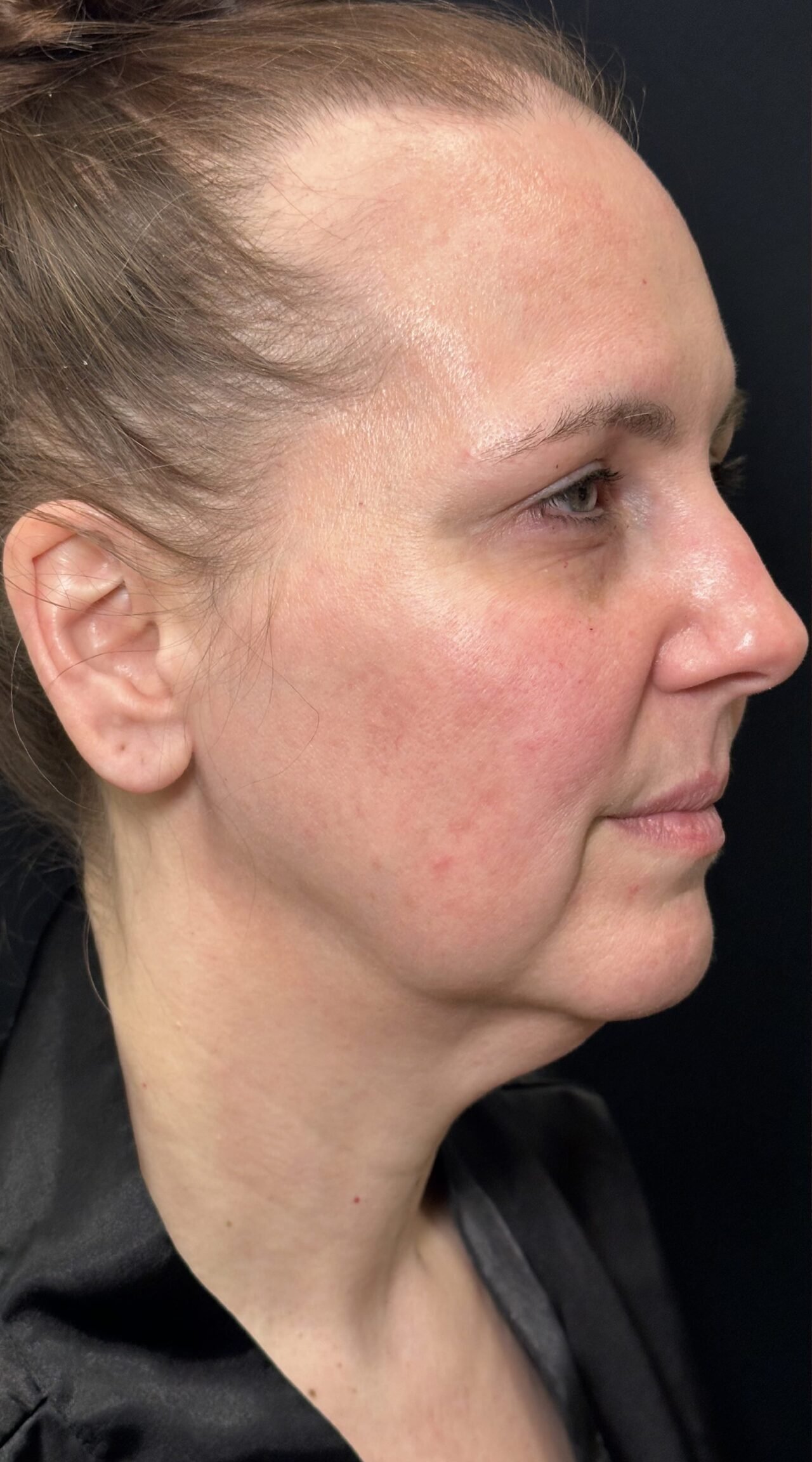 After Botox Forehead treatment result at LIV Med Spa Spring TX