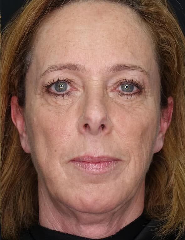 Before Hydrating Facial treatment at LIV Med Spa Spring TX