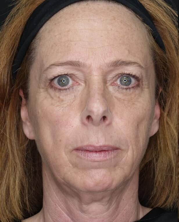 After Hydrating Facial treatment result at LIV Med Spa Spring TX